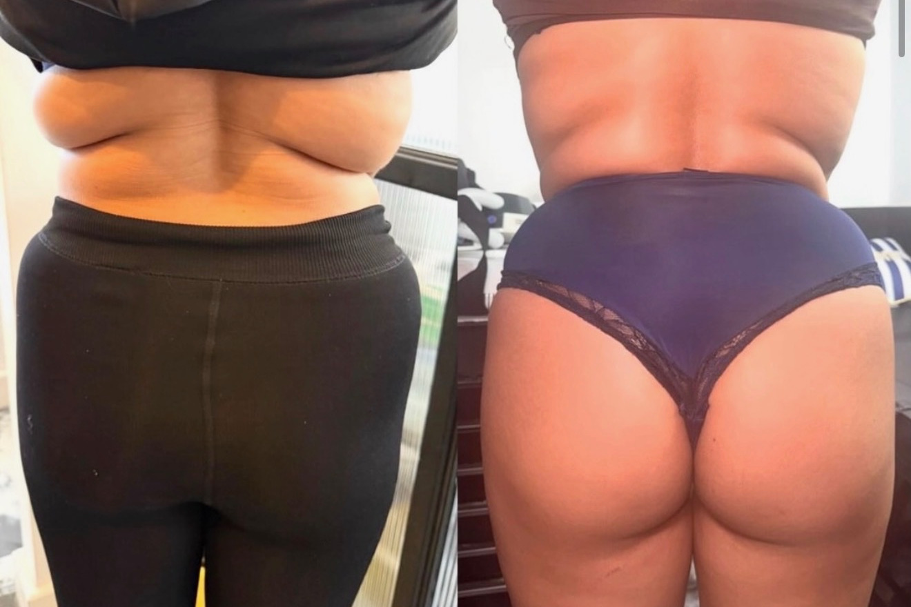 Body contouring